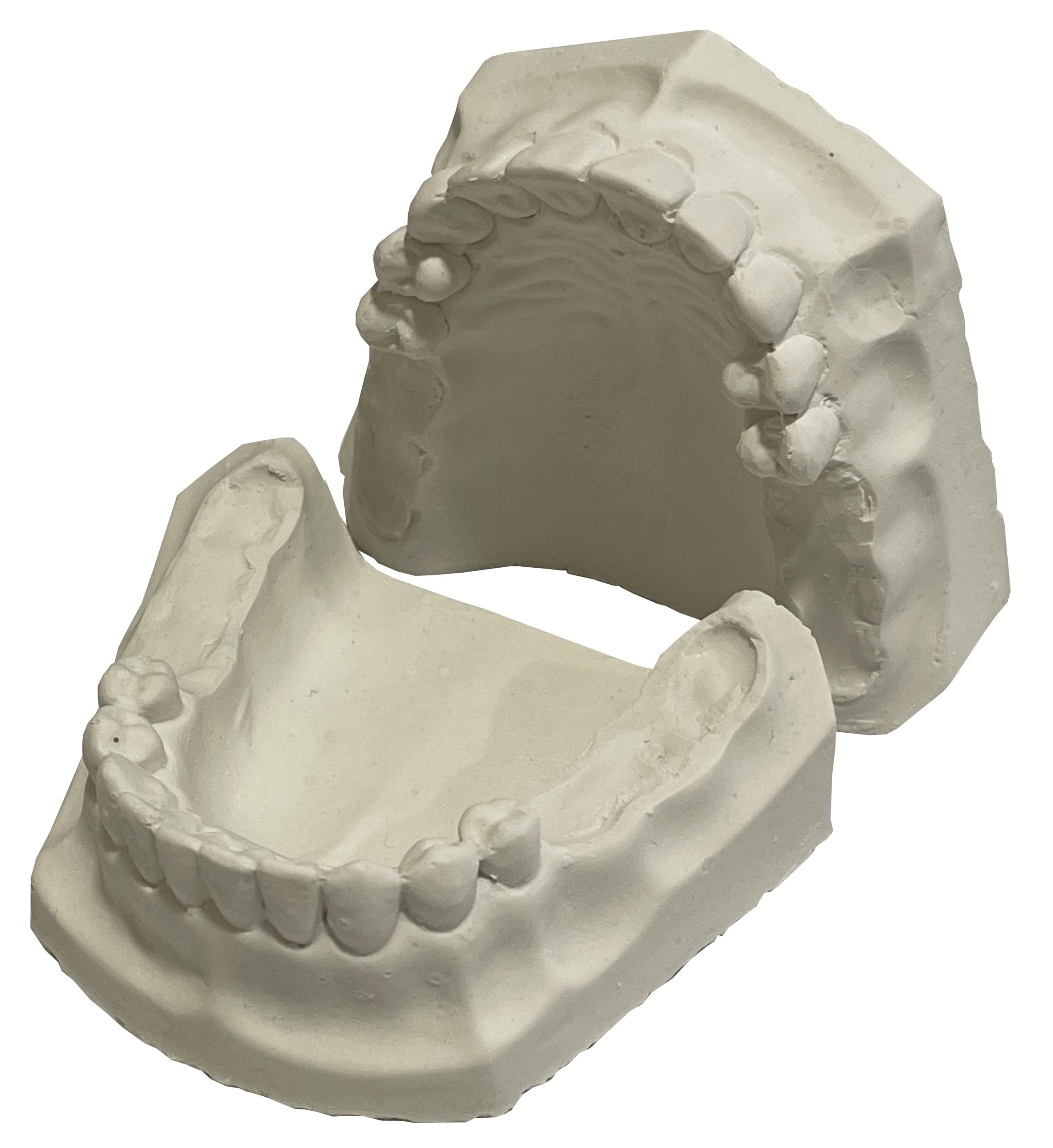 Modelo De Yeso Kennedy Tipo I