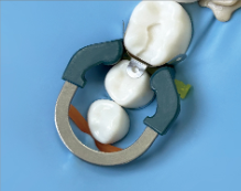 Anillo Niti anatomico p/clase II Azul R6 DENTPARK - Imagen 2